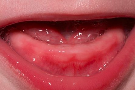 Khám phá từ A đến Z về tình trạng chậm mọc răng ở trẻ