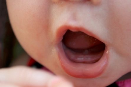 Bật mí cho bạn tất cả các nguyên nhân chậm mọc răng ở trẻ
