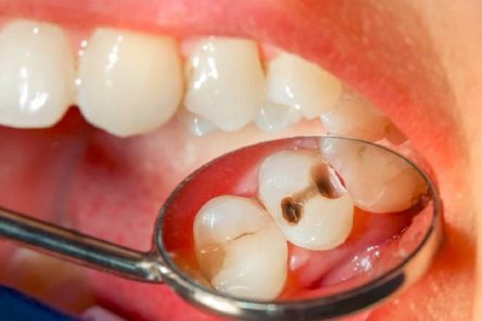 Cung cấp cho bố mẹ các nguyên nhân trẻ sâu răng phổ biến nhất