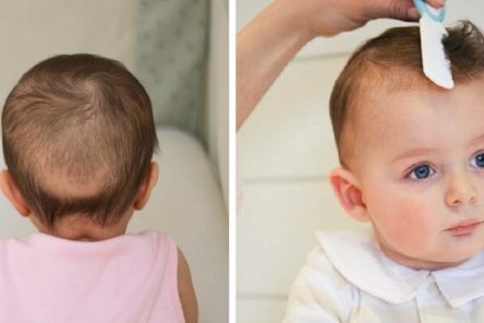 Cách chữa rụng tóc vành khăn cho trẻ cực kỳ hiệu quả